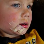 Tory gets stitches